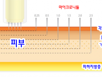 MTS (마이크로니들 시스템)